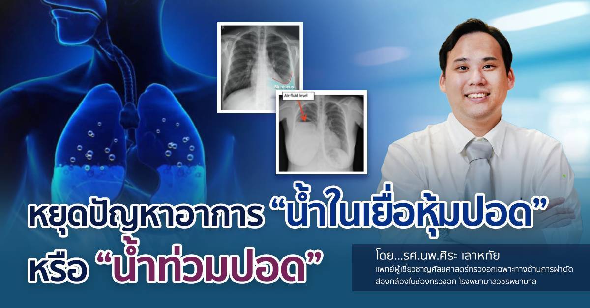 หยุดปัญหาอาการ “น้ำในเยื่อหุ้มปอด” หรือ “น้ำท่วมปอด”