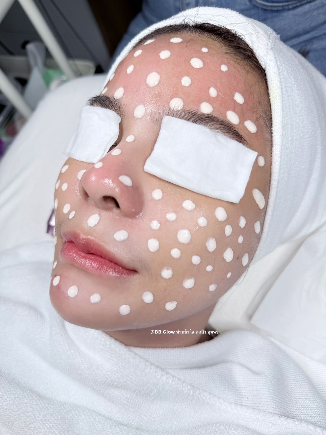 รีวิวกดสิว ชุมพร ก่อนหลัง