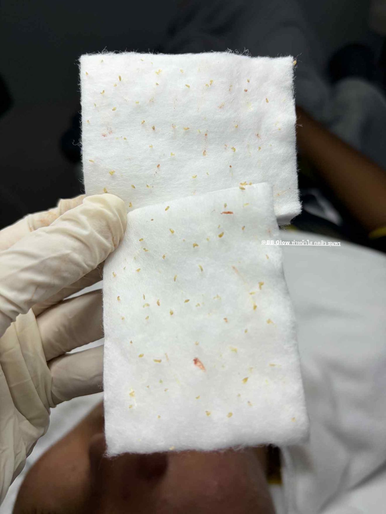 กดสิวอย่างมืออาชีพ รีวิว ชุมพร