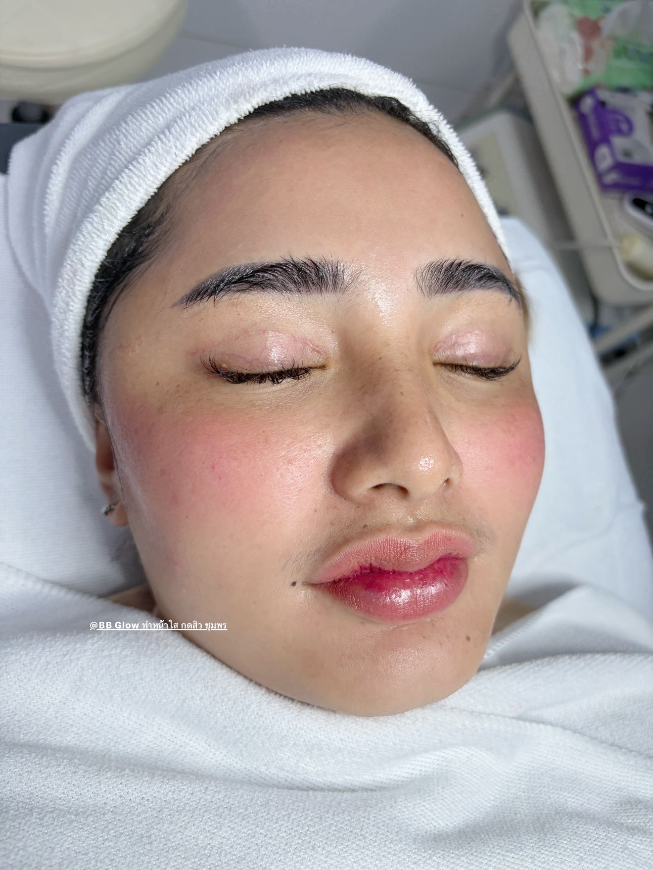 BB Glow ชุมพร รีวิวก่อนหลัง