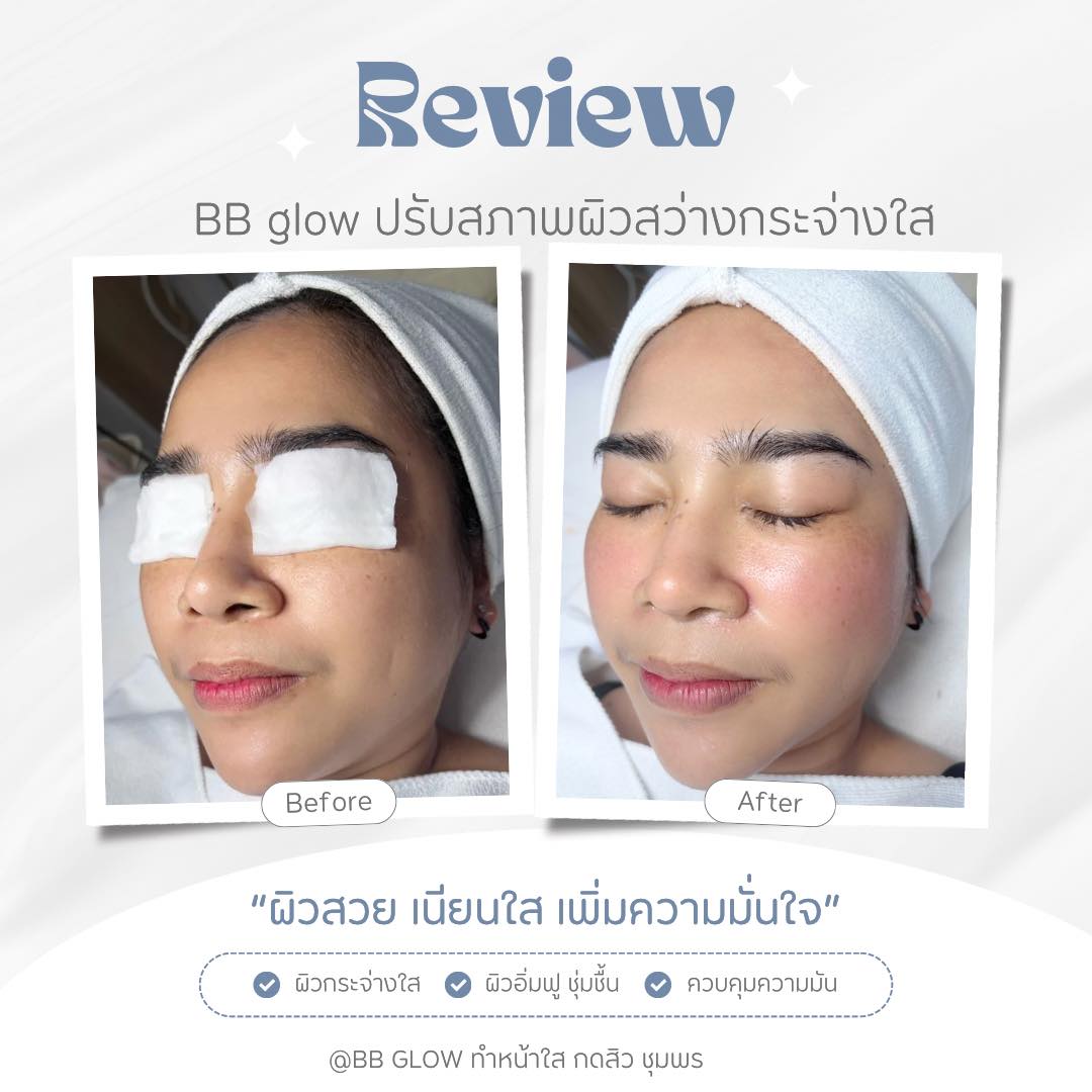 BB Glow หน้าเนียนใส ชุมพร