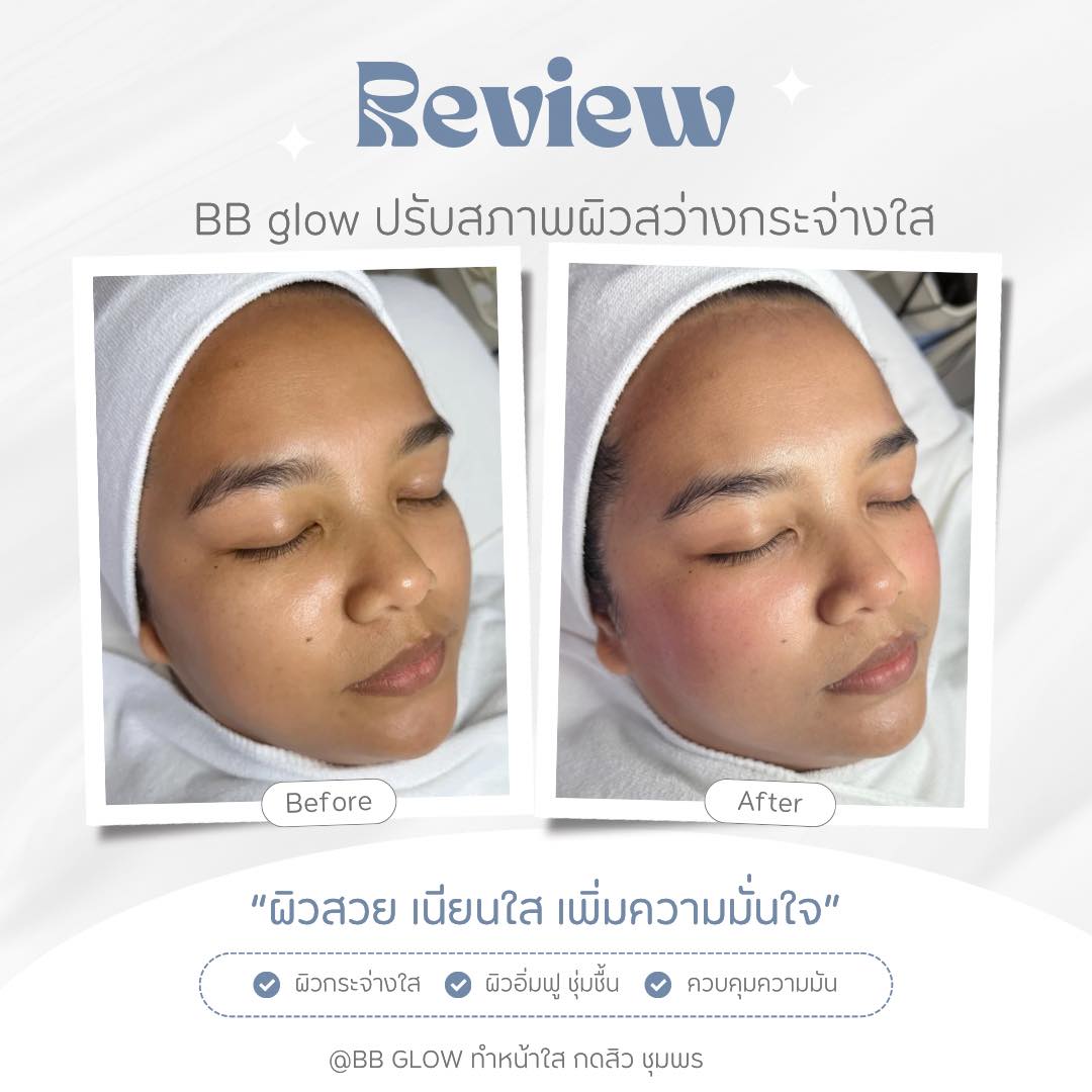 ทำหน้าใสโดยผู้เชี่ยวชาญ ชุมพร