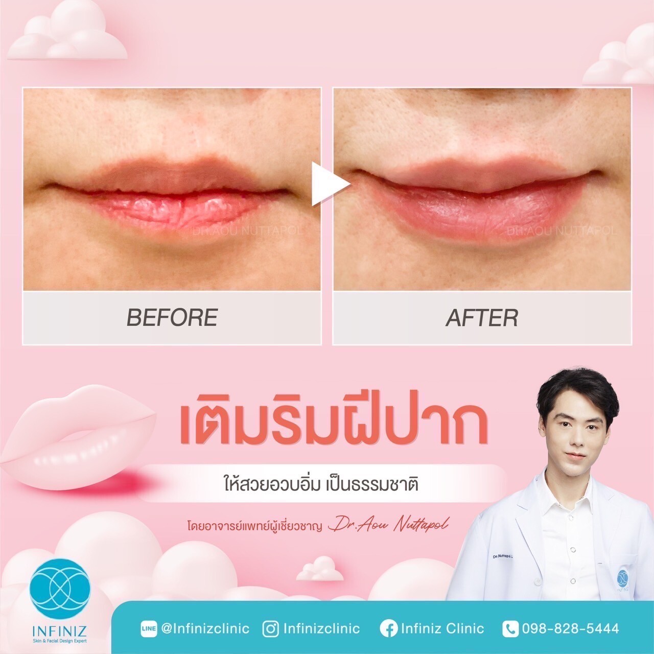 ฟิลเลอร์ปาก before and after